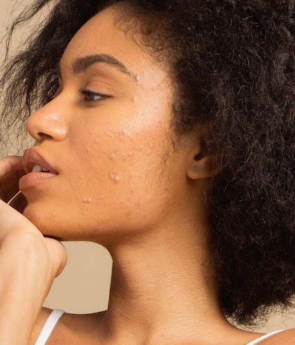 Acne: causes, treatment and best k-beauty products for acne